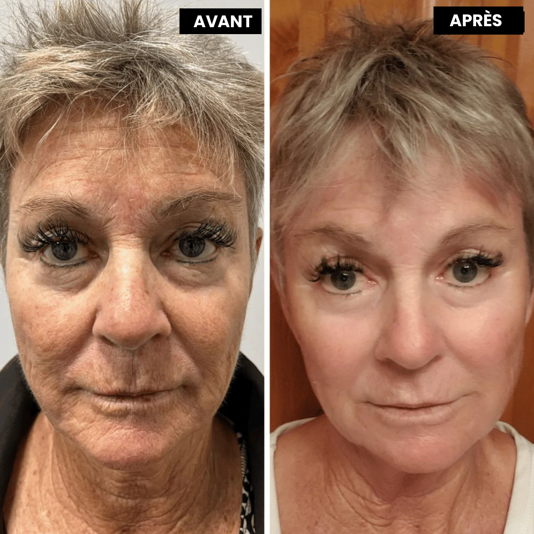 Lyvonelle™ La nouvelle alternative au rétinol